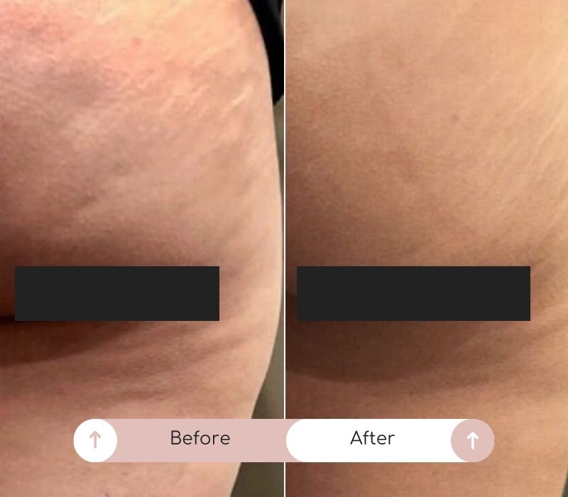 sculptra body before after